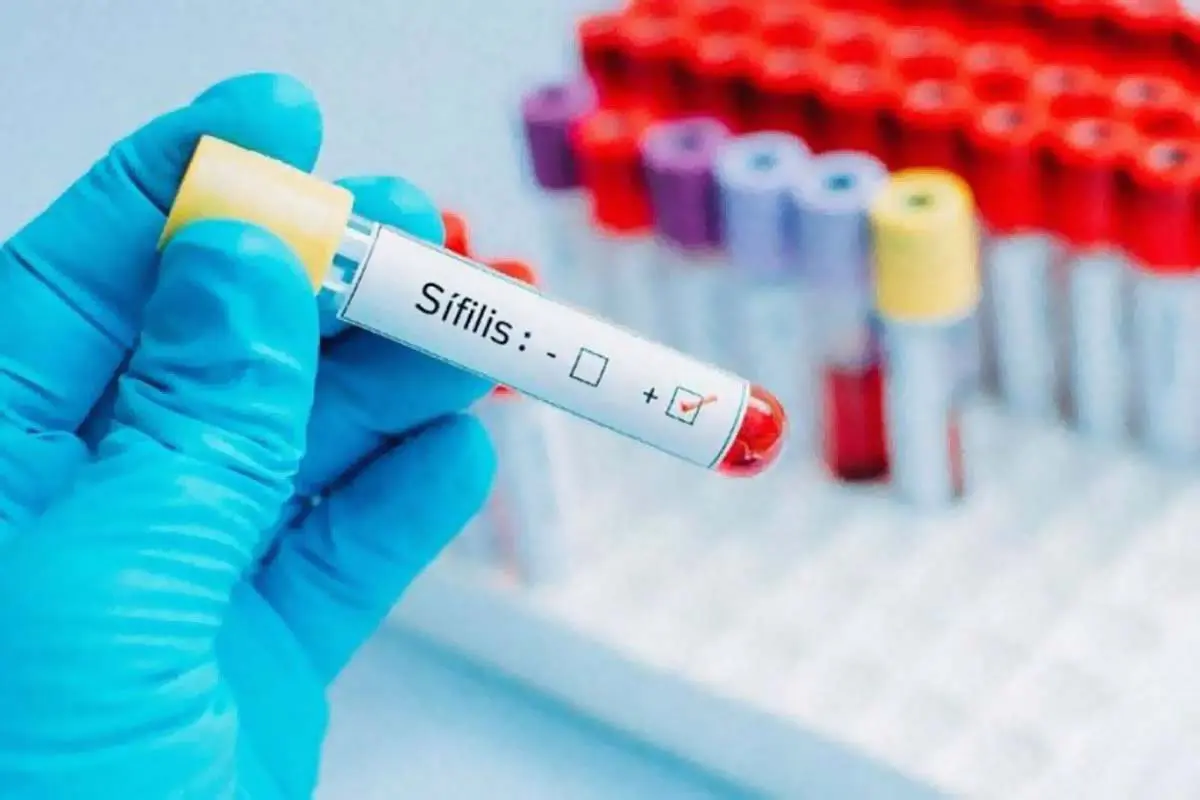 Sexo inseguro: Impactante suba de casos de sífilis en la provincia de Santa Fe