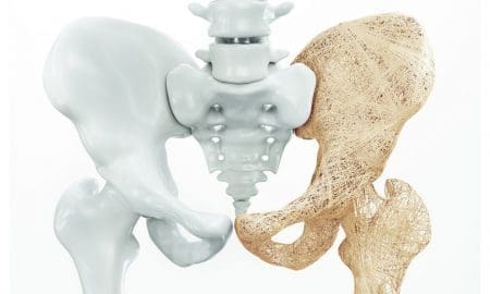 Osteoporosis: la importancia de la detección temprana y los hábitos saludables para minimizar sus riesgos