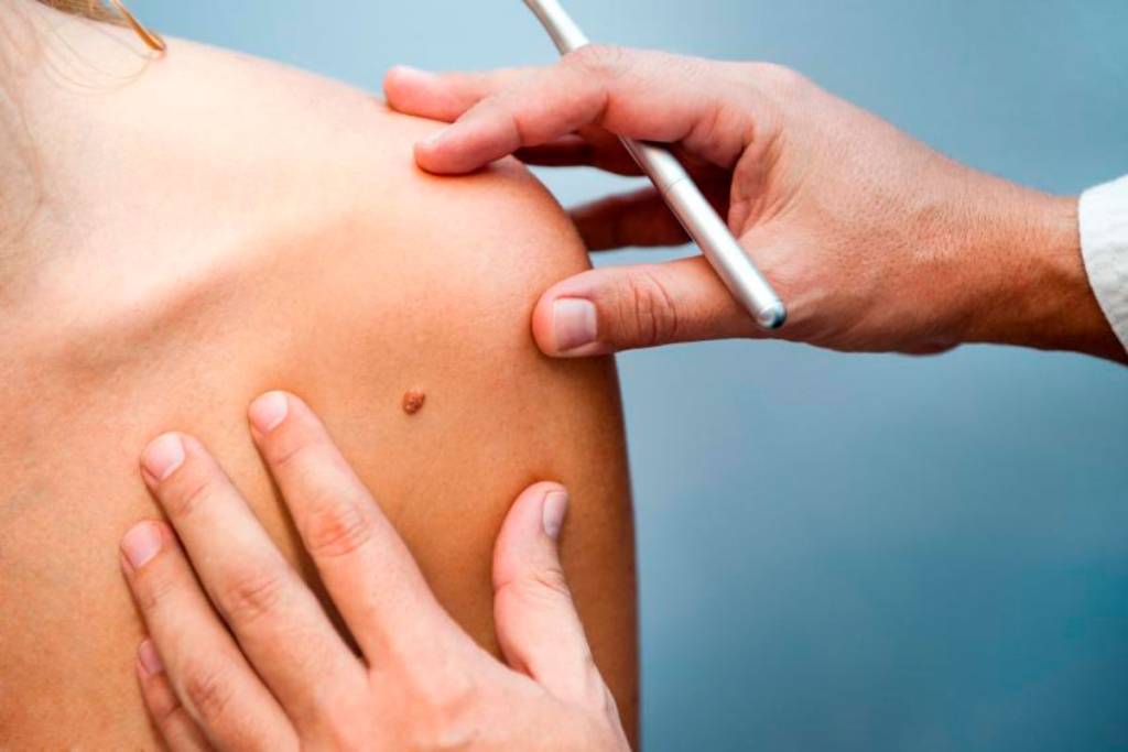 Argentina será el primer país en usar una vacuna contra el cáncer de piel más agresivo