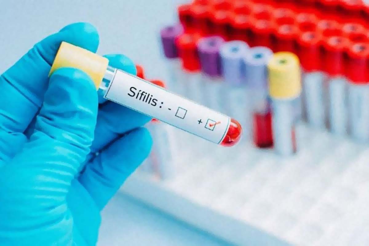 Sexo inseguro: Impactante suba de casos de sífilis en la provincia de Santa Fe